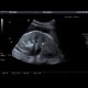 Hydronephrosis, mild edema of kidney: US - Ultrasound
